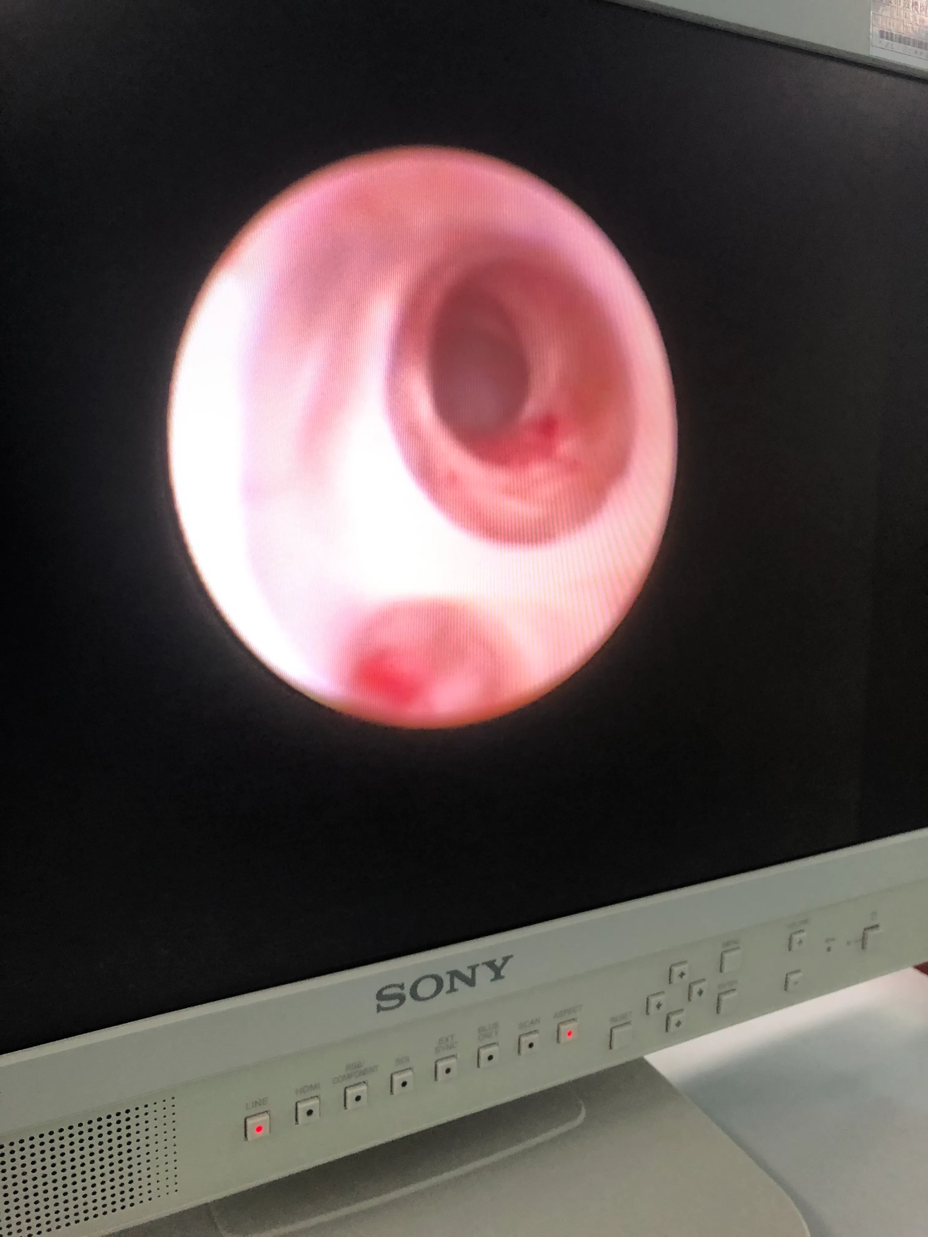 手术日志29:精囊镜手术治疗血精、无精,精索静脉曲张显微手术