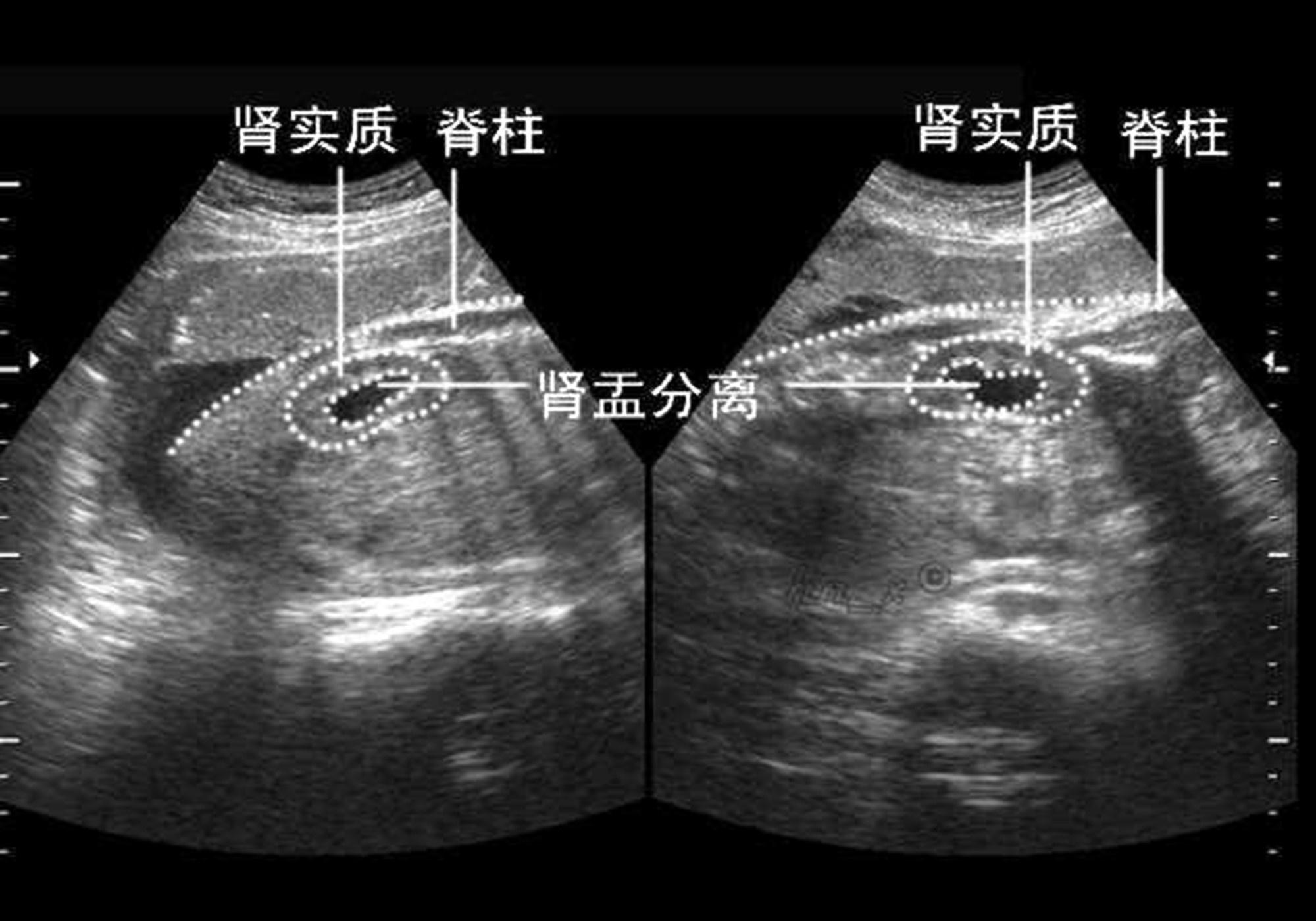 什么是肾盂分离 导致肾盂分离的原因与处理办法