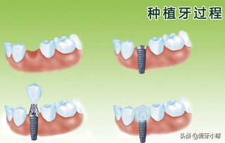 牙齿松动怎么办？别急！这几种方法来解救你