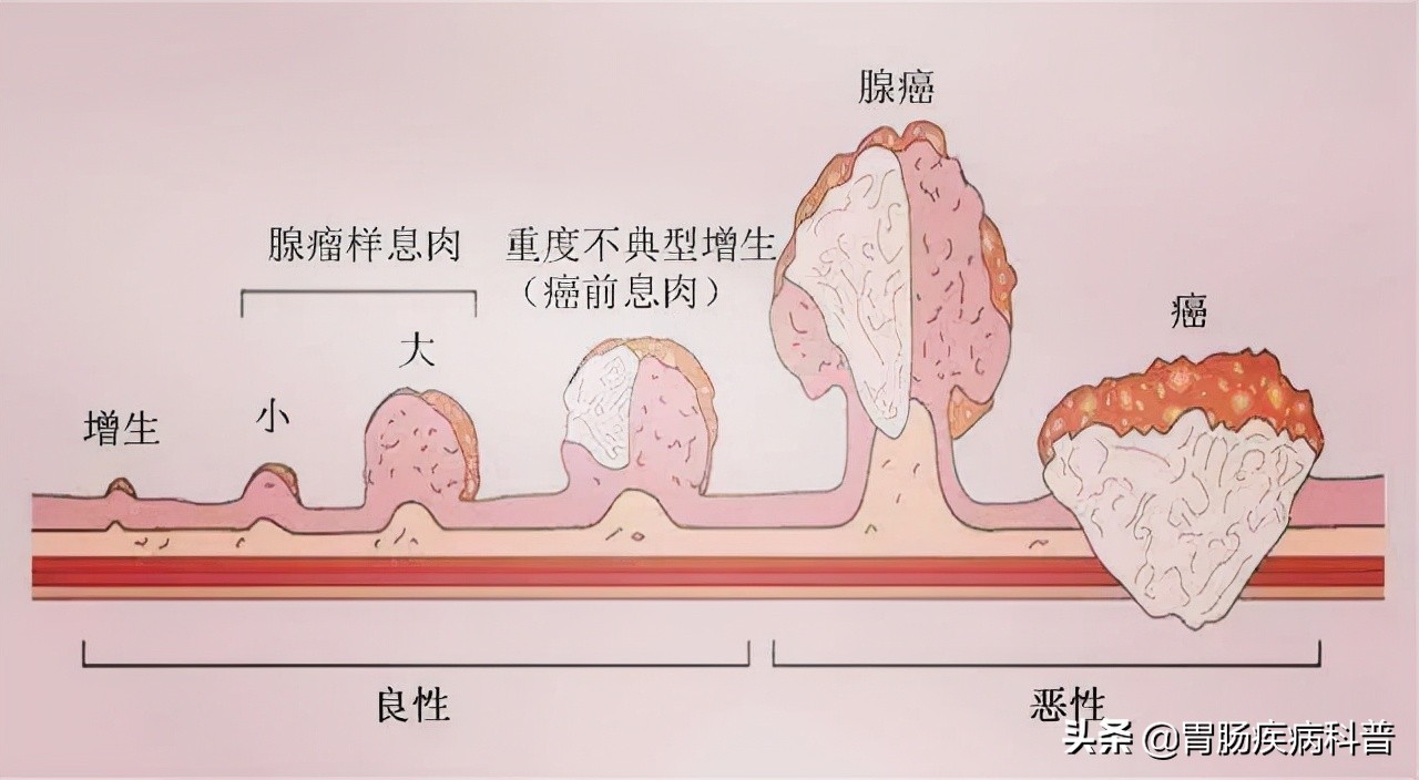 年過40,腸鏡要做,息肉要切