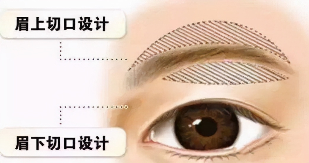 眼皮下垂如何自然恢复？眼周皮肤松弛改善方法