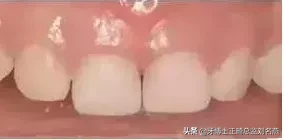 什么是预成冠?儿童乳牙的保护伞