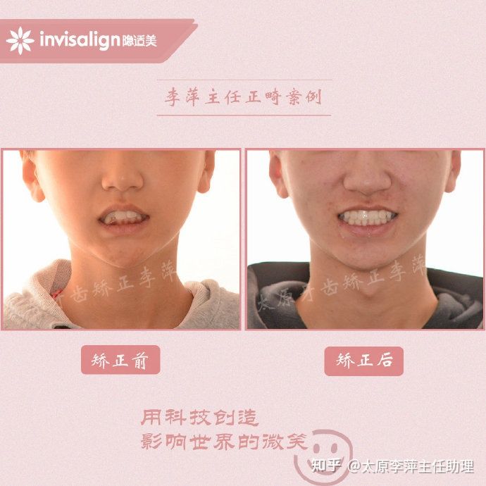 太原牙齿矫正：隐形牙套效果好不好？看这些病例你就知道了