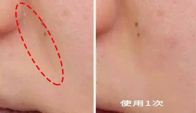 让日本女人夜夜疯狂的神器，法令纹、眉间纹克星！一贴＝10次除皱