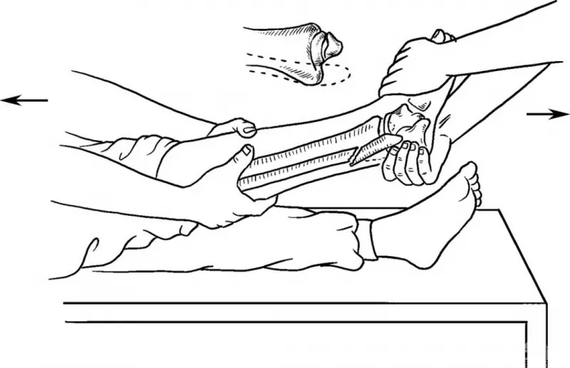关于踝部骨折的闭合复位,看这一篇就够了