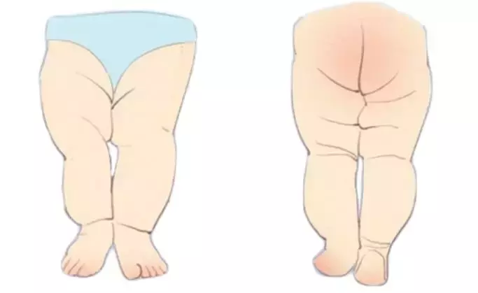 发育性髋关节脱位致残率高,该如何早期发现呢?