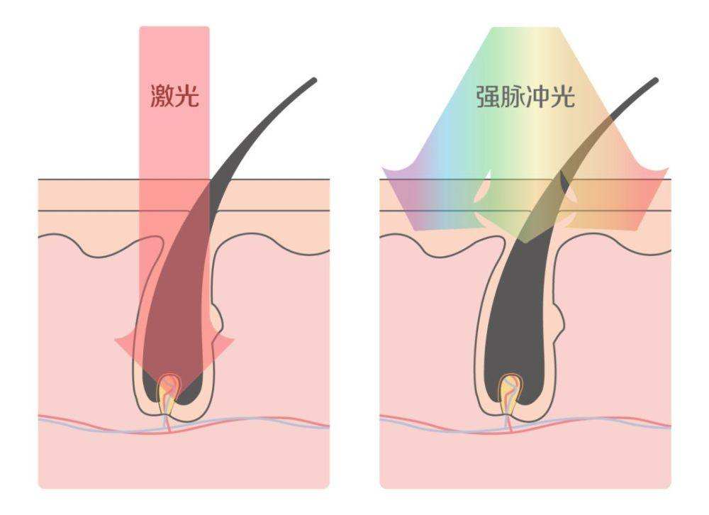 入门级科普：“五花八门”的激光美容项目，女人怎么选？