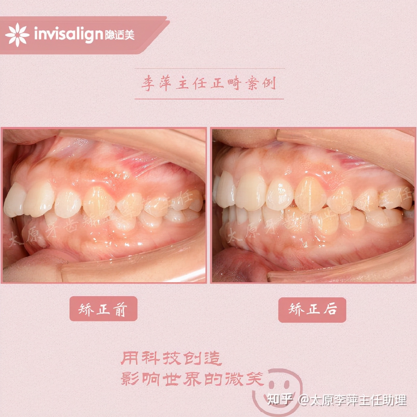 太原牙齿矫正：隐形牙套效果好不好？看这些病例你就知道了
