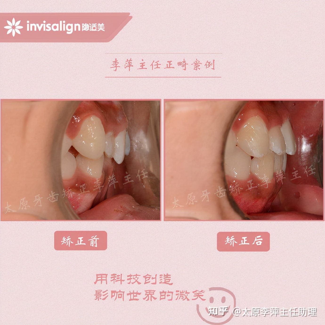 太原牙齿矫正：隐形牙套效果好不好？看这些病例你就知道了