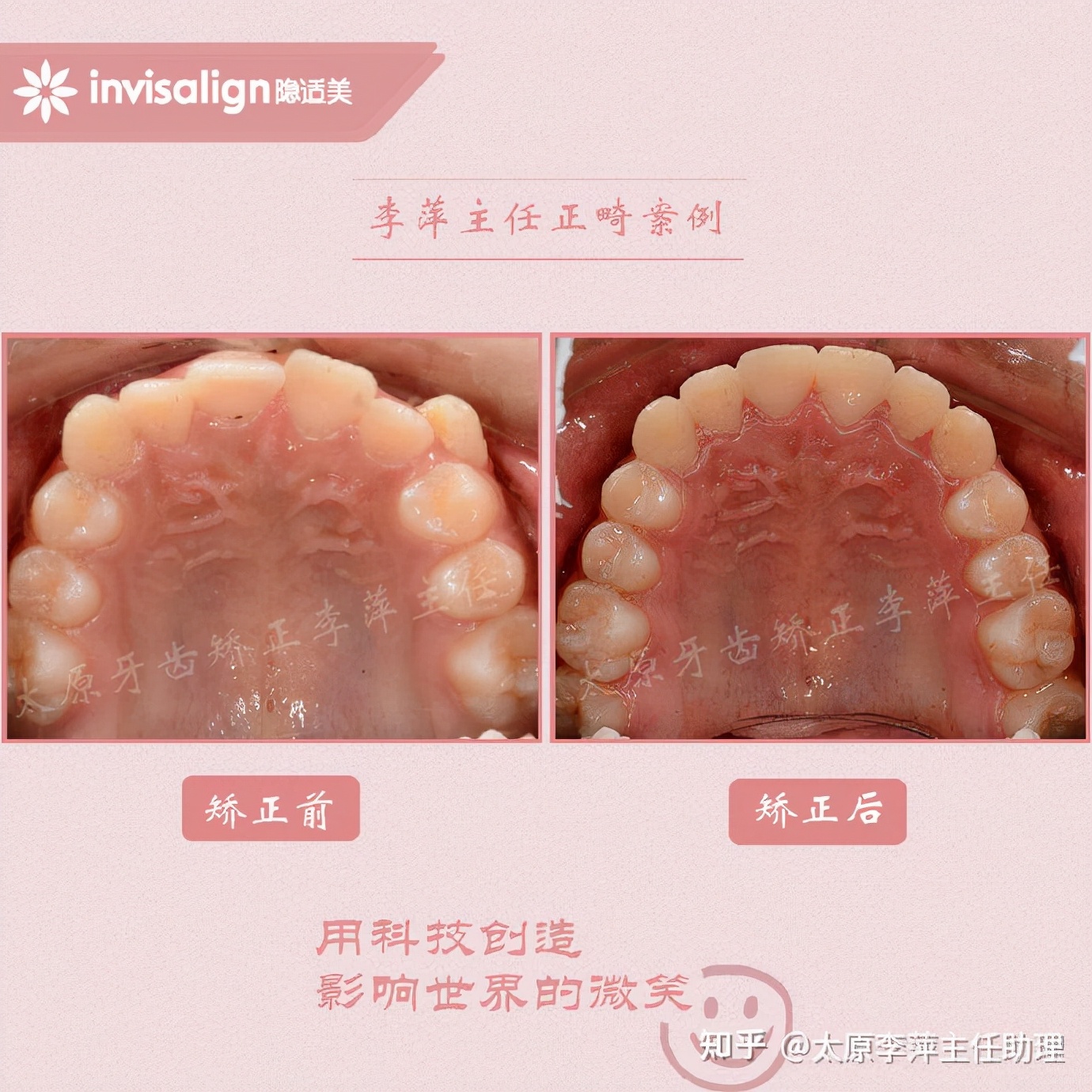 太原牙齿矫正：隐形牙套效果好不好？看这些病例你就知道了