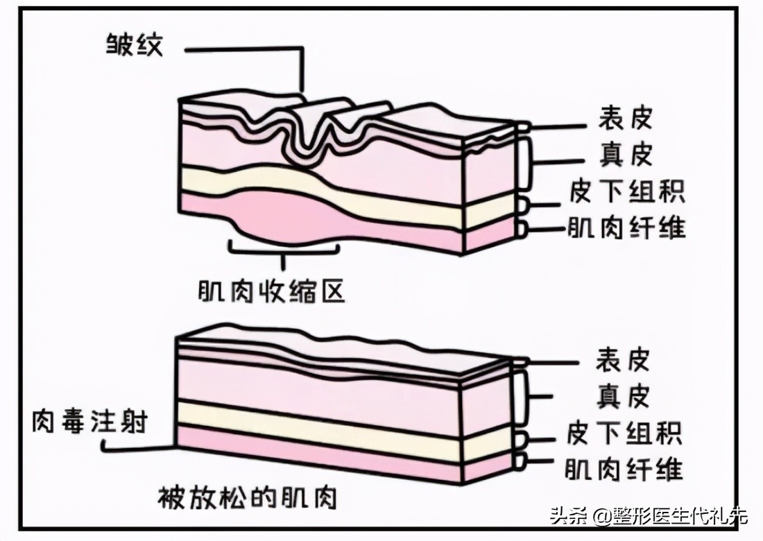 有了抬头纹要怎么办？会让人显老显衰压眼睛，有抬头纹的来看看