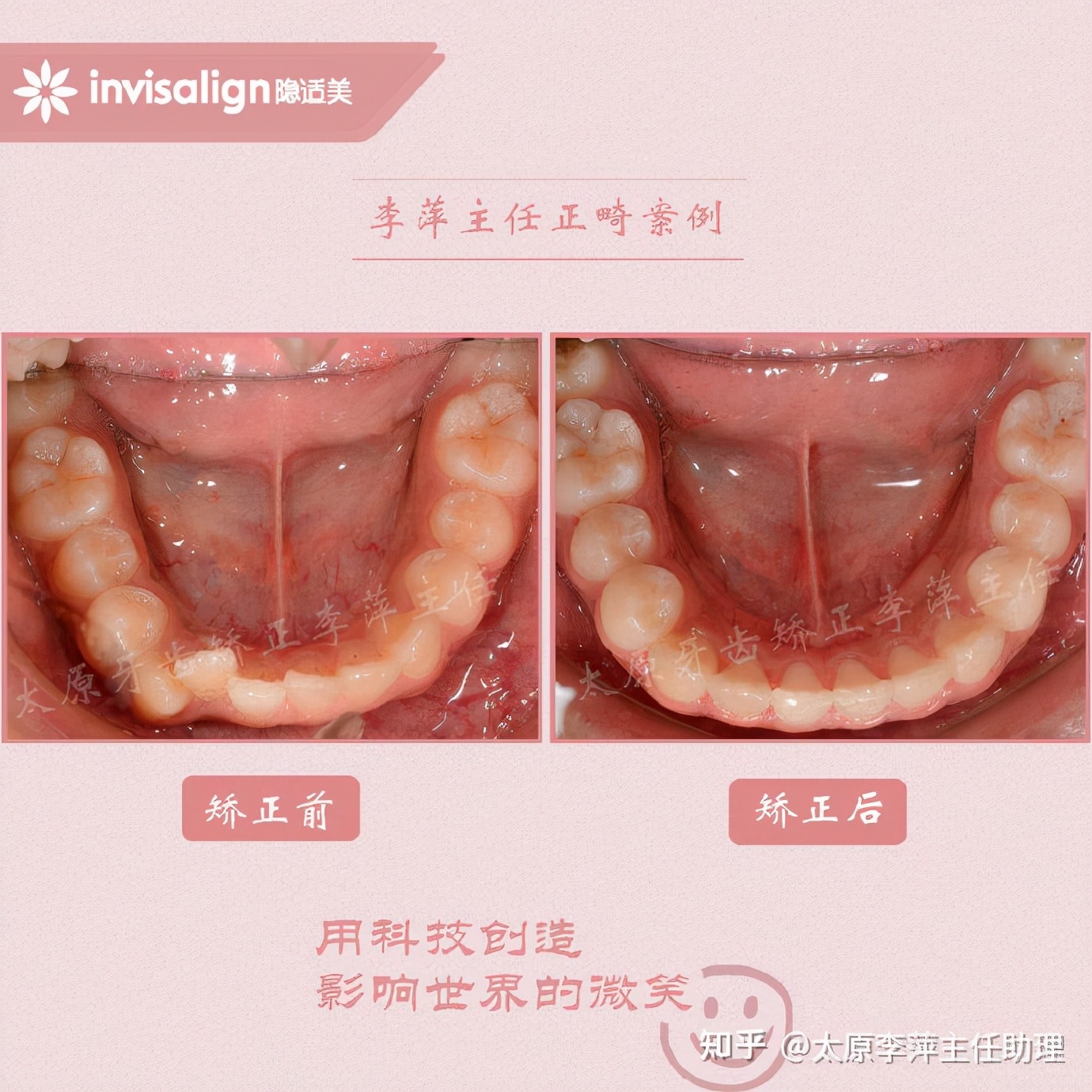 太原牙齿矫正：隐形牙套效果好不好？看这些病例你就知道了