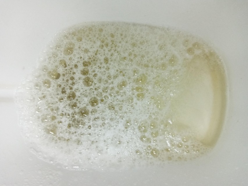 泡泡尿蛋白尿外观图片图片