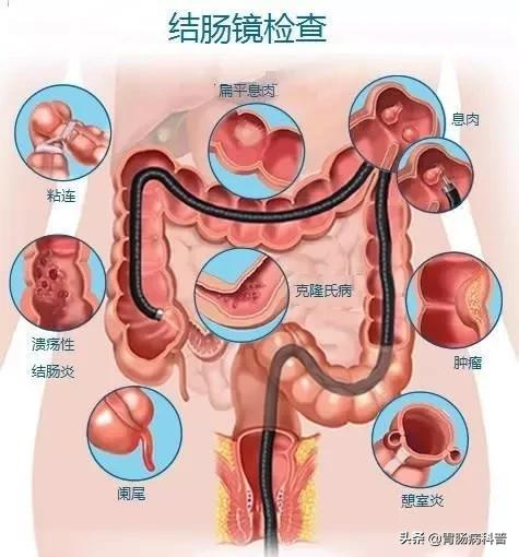 肠镜不是人人都能做——做肠镜，应该注意哪些事情？