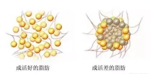 脂肪隆胸 | 自体脂肪隆胸，真的一年就没了吗？