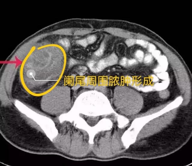 急性阑尾炎一定要手术吗?选择开刀？还是腹腔镜手术?