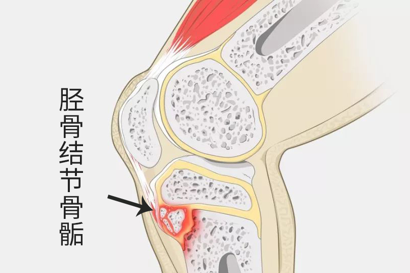 运动有助于孩子增高，但要适当！否则增高不成，反让关节出问题