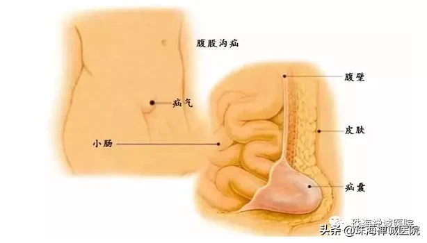 转给爸妈：发现疝气要重视，及时治疗不能拖