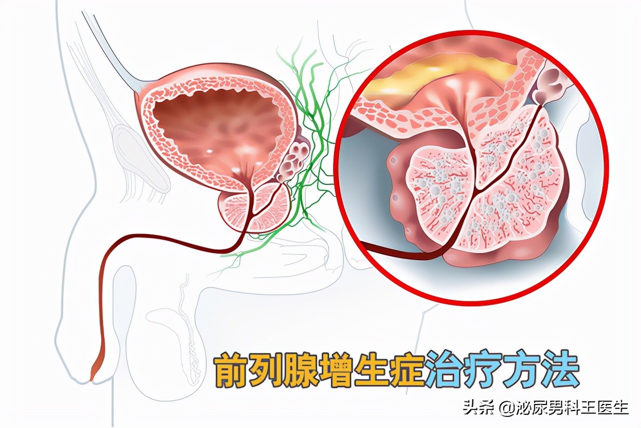 中老年人得了前列腺增生应该怎么办？