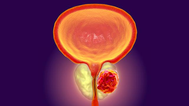 5个症状出现,男人小心睾丸癌