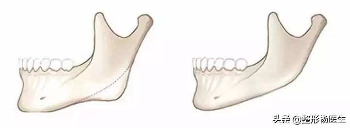 面部轮廓太重要了，明星们做磨骨手术，国字脸变成瓜子脸
