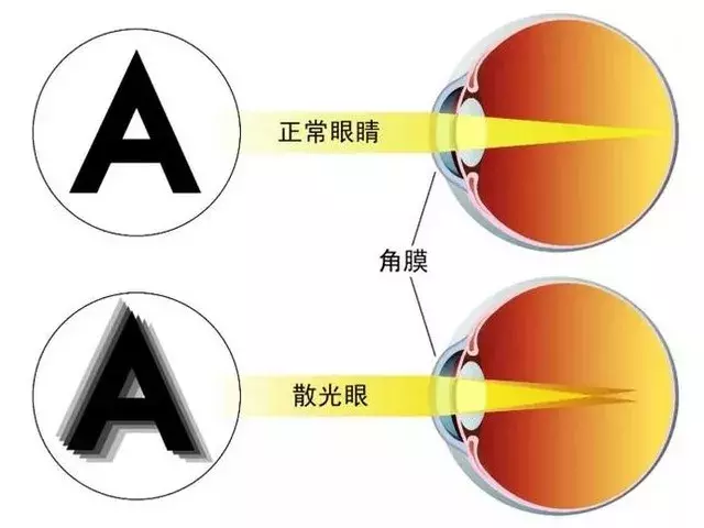 家长要知道:孩子的近视与散光