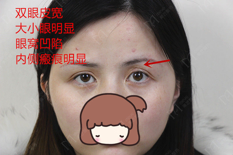 男人割双眼皮男人割双眼皮对面相的影响