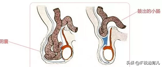 5个月宝宝疝气导致肠坏死，婴儿疝气应该引起大多数家长重视！