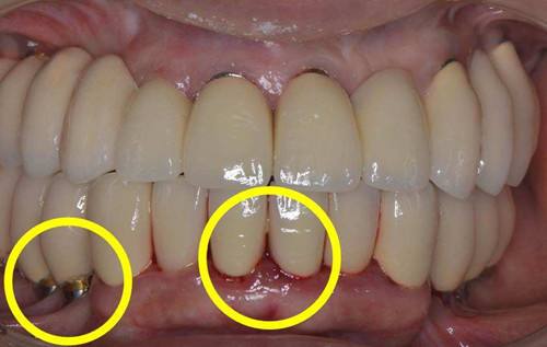 1,牙龈颜色正常牙龈呈粉红色,患龈缘炎时游离龈和龈乳头变为深红或暗