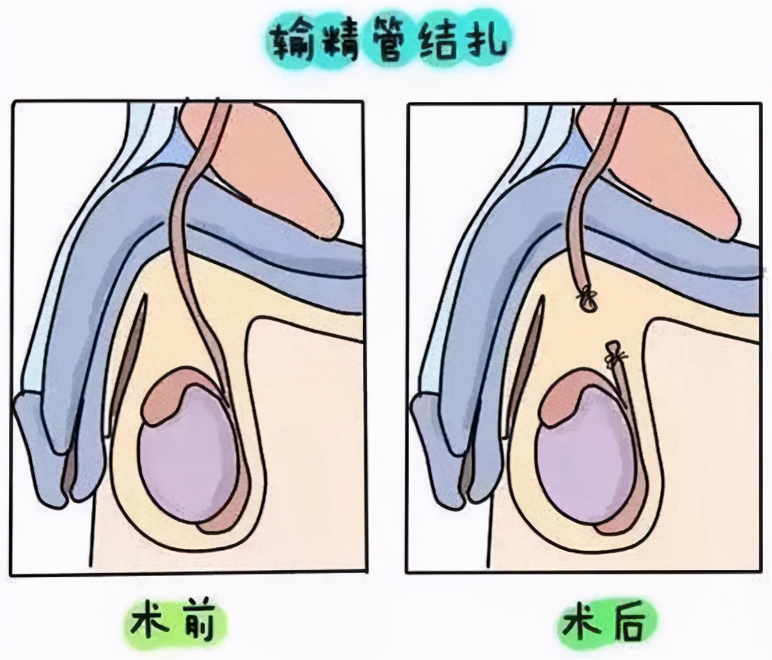 输精管结扎术是什么?手术应该怎么做?