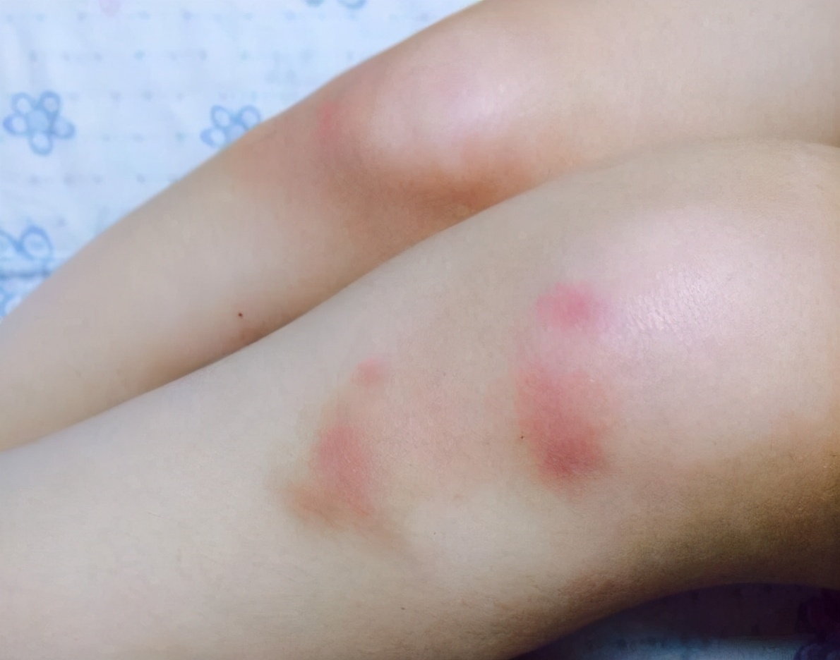 而这些被忽视的症状预示着血小板减少症的发生.