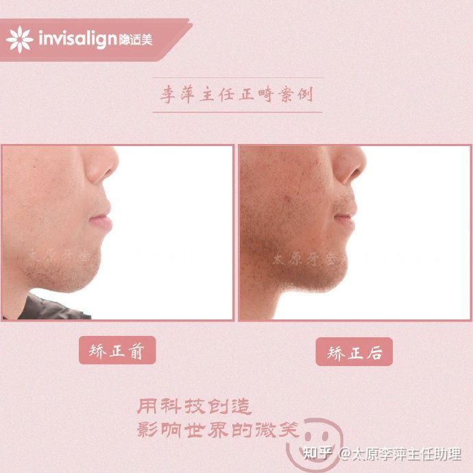 太原牙齿矫正：隐形牙套效果好不好？看这些病例你就知道了