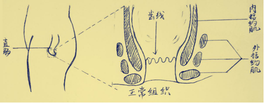拖出来的肛瘘-不要小瞧肛周脓肿