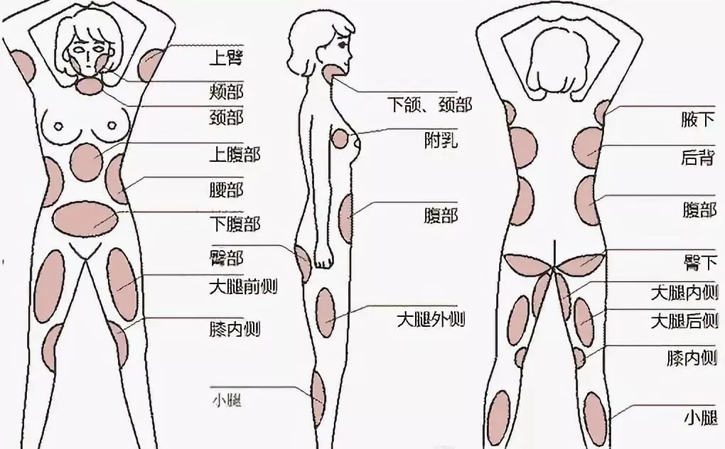 想要轻松享“瘦”就抽脂？抽脂前，一定要清楚这5个问题