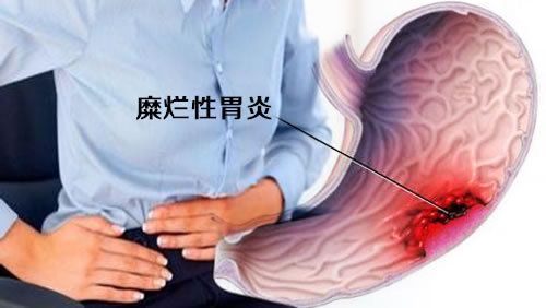 胃糜烂是什么原因引起的？胃部出现糜烂是否意味着病情严重？