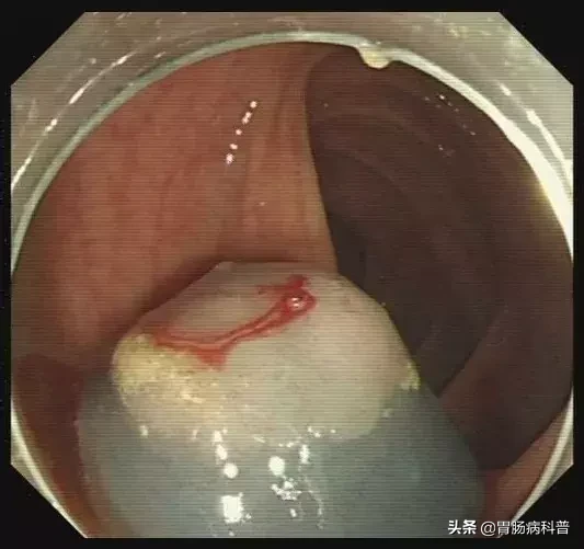 医生是怎样切掉肠息肉的?