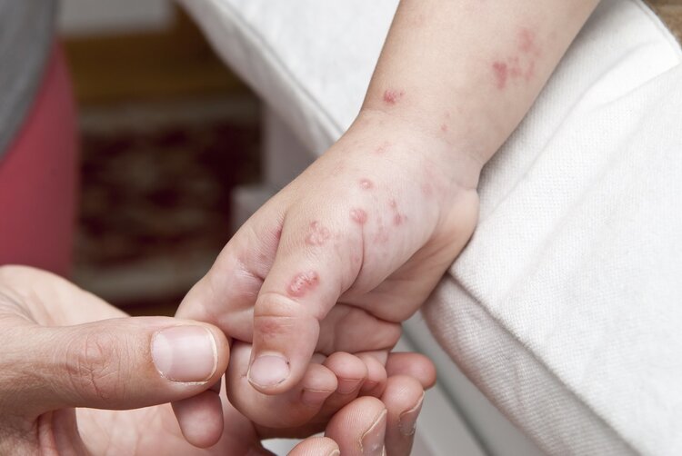 带状疱疹：让人疼痛难忍，还可能是癌症预警，及时就医