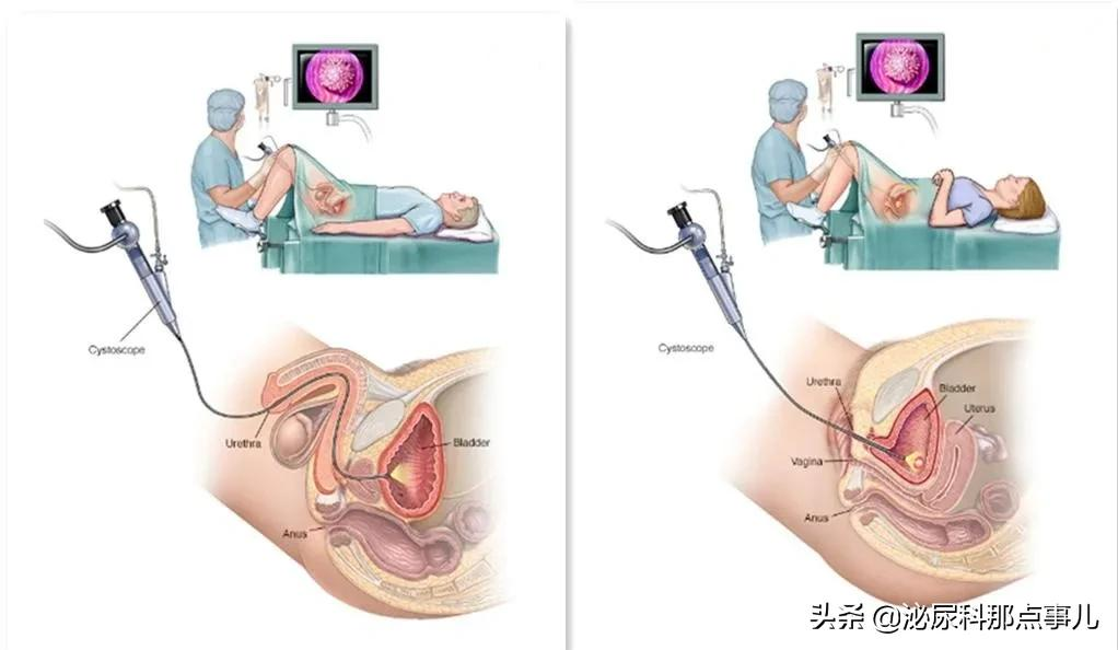 关于软性膀胱镜，你知道多少呢？