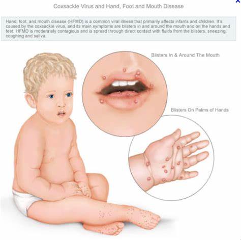 如何鉴别手足口病、疱疹性咽峡炎、水痘三种儿童疾病：把握六个字