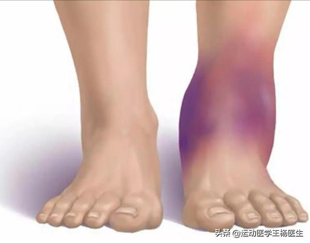 崴脚肿痛应急处理方法