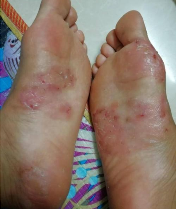 角化型脚气 初期 图片(夏天一脱鞋就臭气熏天) - 赤虎壹号