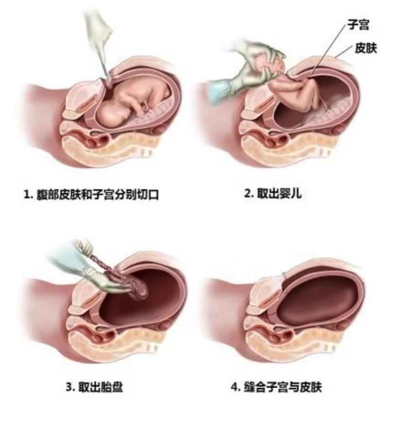 剖腹产到底有多可怕？来看打针都哭的喔喔妈妈怎么说？