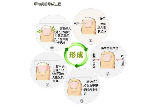 很多人的「甲沟炎」，其实都是自己剪指甲剪出来的