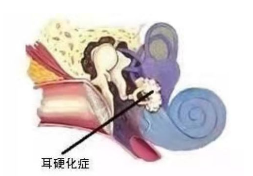 耳鸣、眩晕、听力下降，可能是人体最小的骨头罢工了