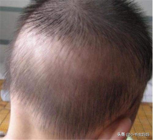 婴儿枕秃怎么办(宝宝枕秃) - 乐宝宝贝