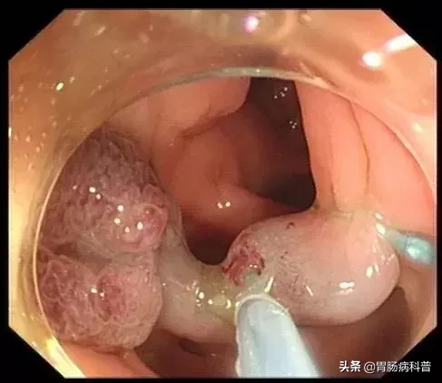 医生是怎样切掉肠息肉的？