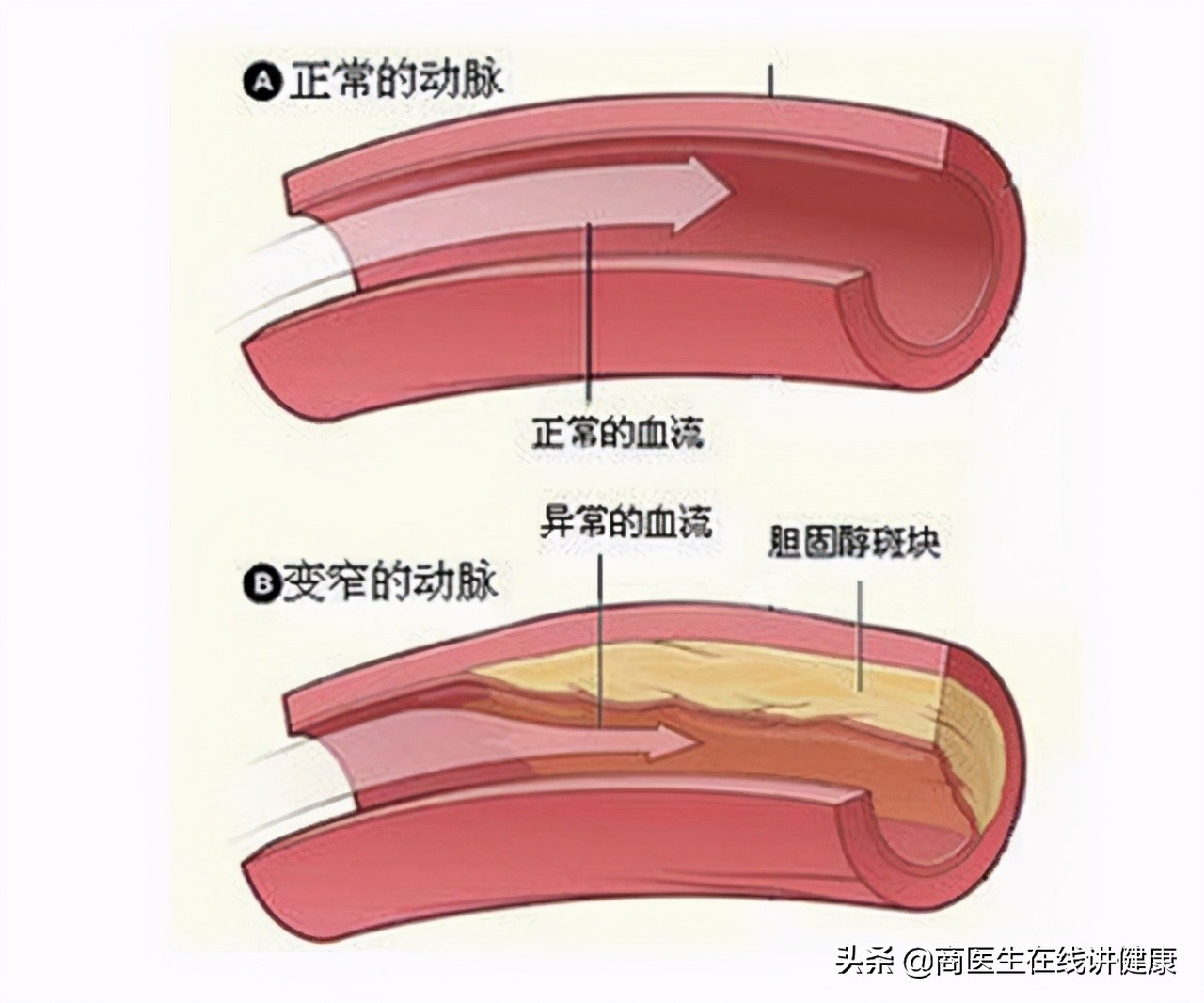 近一半高血压患者也有高尿酸，这两者有什么关系？治疗有何区别？