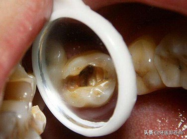 根管治疗是在牙齿上做了什么？根管治疗后牙齿还能用多久？