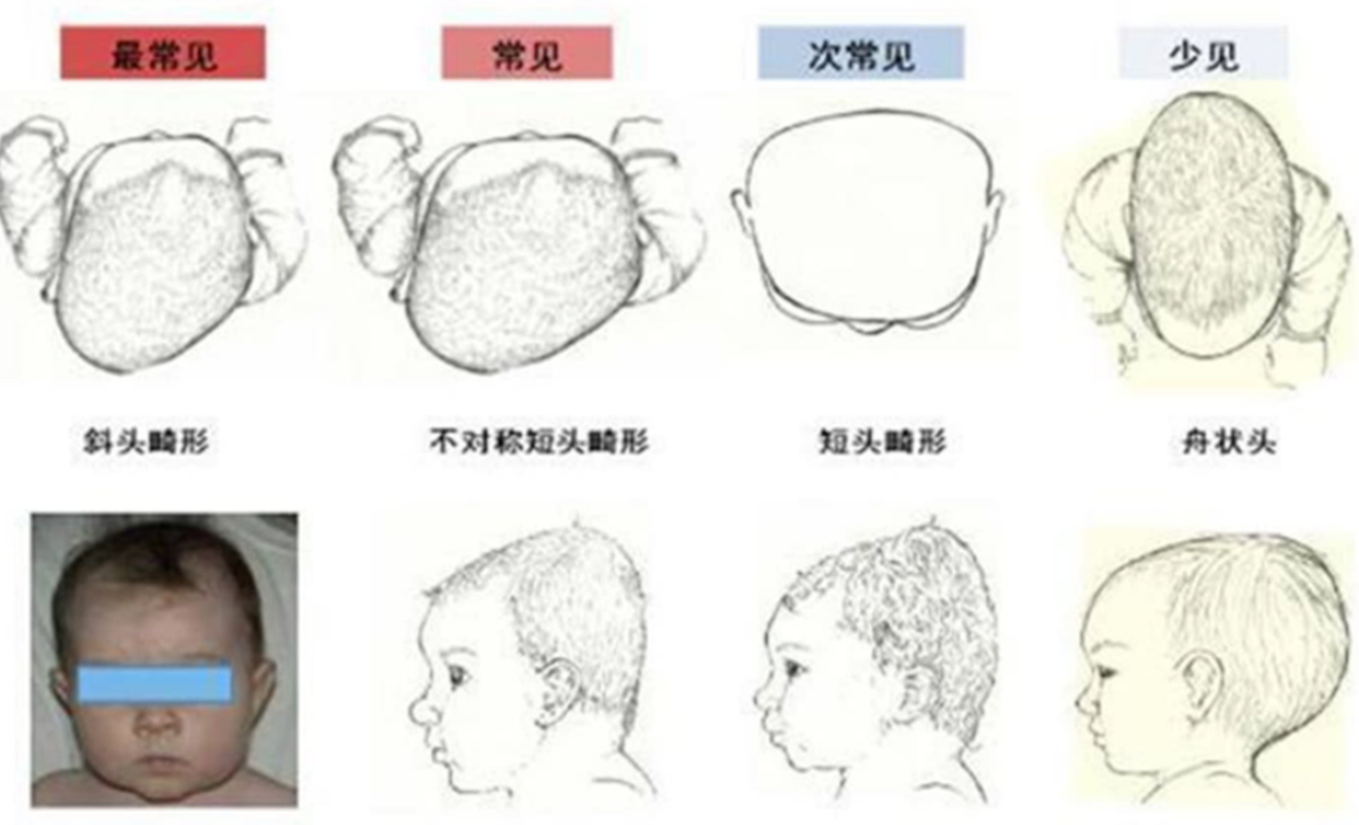 龍鳳胎一個扁頭一個圓頭,寶媽抓緊矯正,別等孩子長大後埋怨你