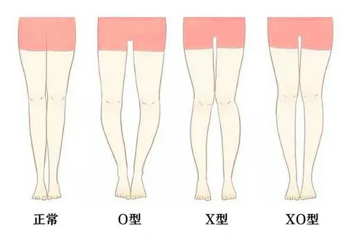 看完这篇,轻松甩掉X型腿